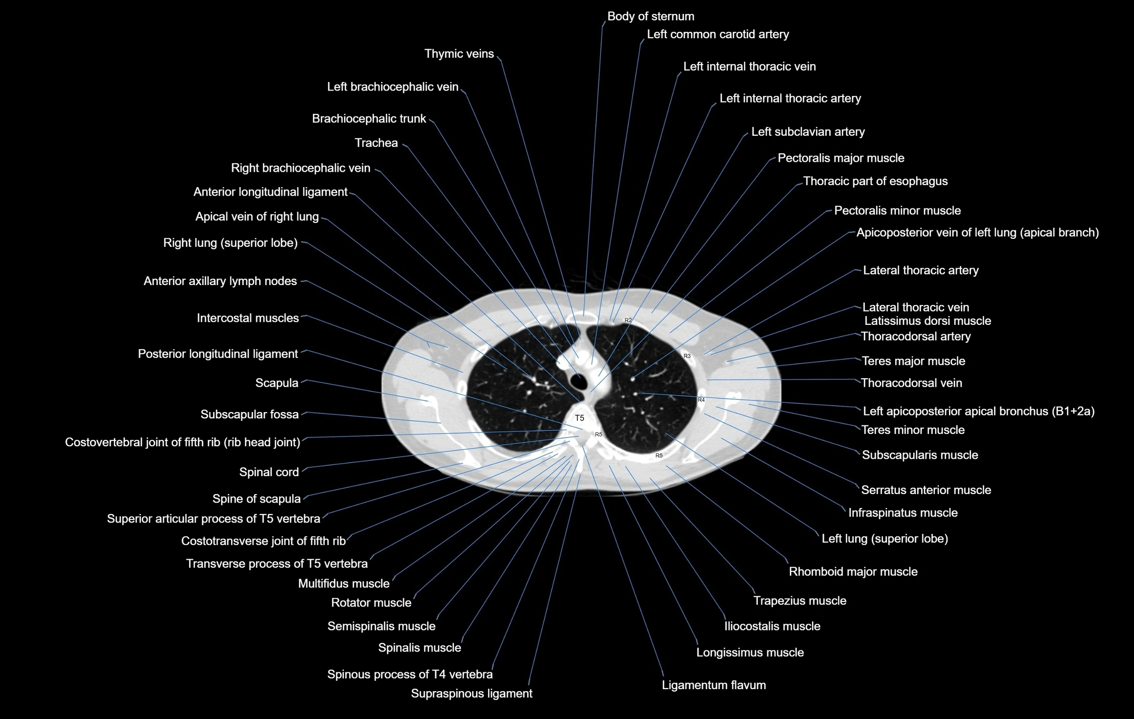 CT chest (thorax) lung window window labelled axial cross sectional anatomy radiology image-00031.webp